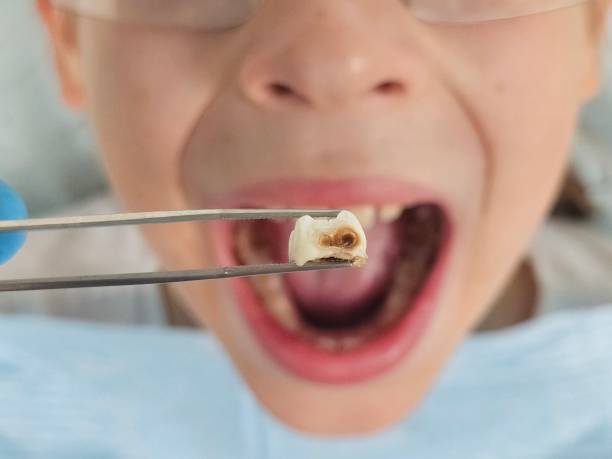 Best Emergency Tooth Extraction in Havre De Grace, MD